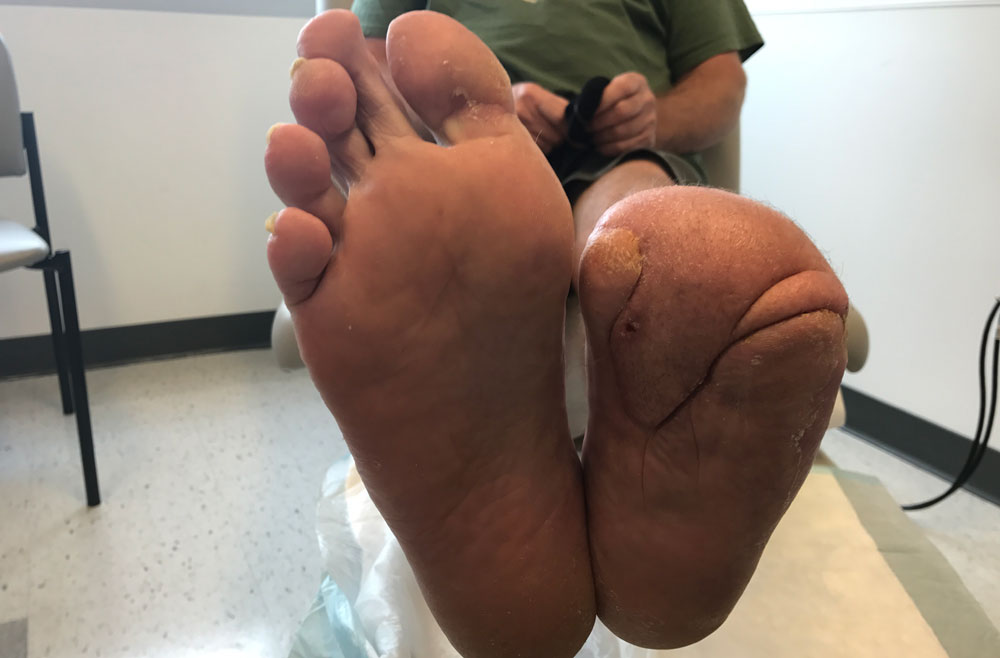 Patient's foot after orthopaedic surgery